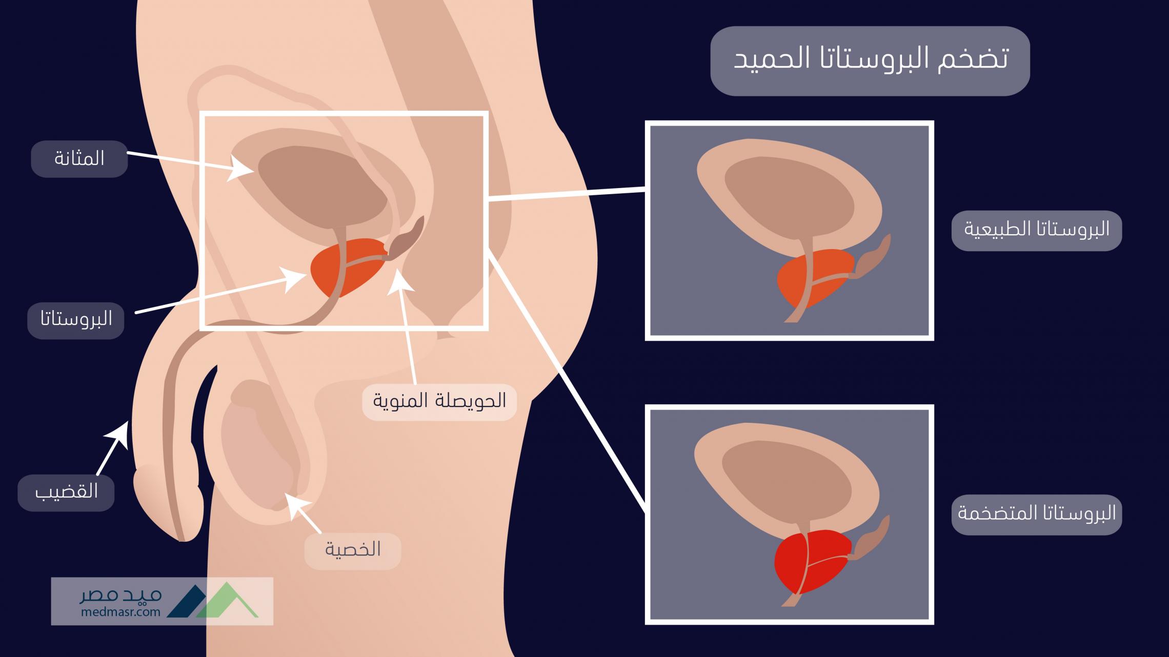 علاج الهربس التناسلي 5568 1