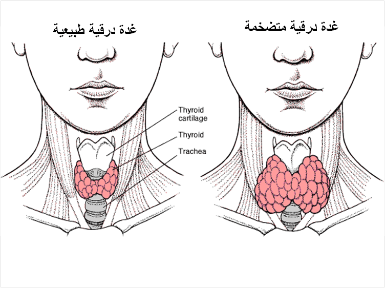 علاج الغدة الدرقية بالقسط الهندي - وصفة سحرية للعود الهندى فى علاج الغدة 1529