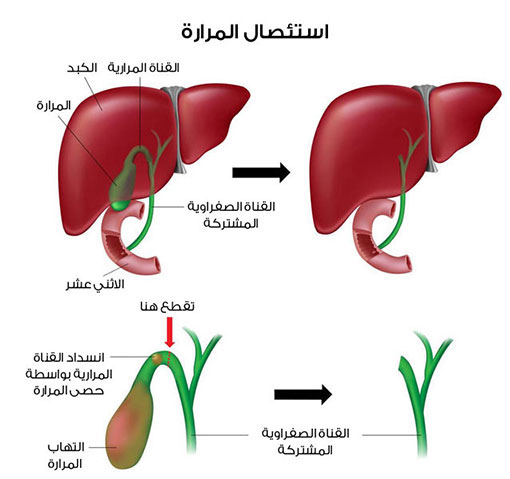 اسباب انتفاخ المرارة - ما لا تعرفه عن انتفاخ المرارة 3703 2