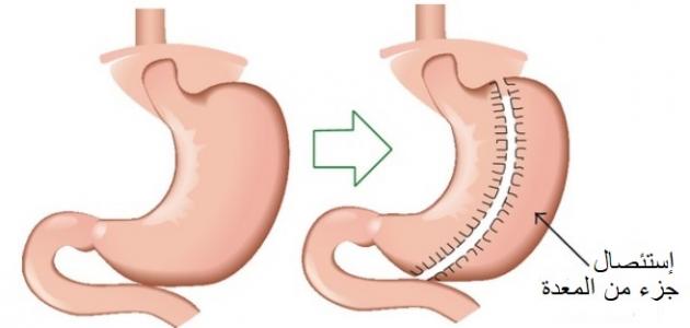 عملية تكميم معدة - طريقة تكميم المعدة 3552