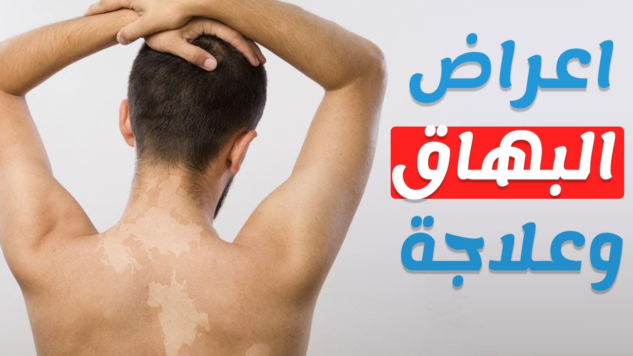 مرض البهاق اسبابه وعلاجه , تعرف على مرض البهاق