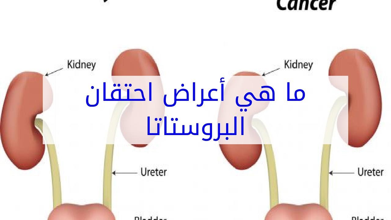 اعراض احتقان البروستاتا - لو شعرت بهذه الاشياء فالبروستاتا محتقنة فاحذر 266 1