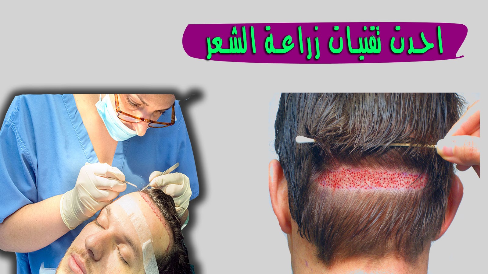 افضل تقنية لزراعة الشعر - احسن الطرق لزراعة الشعر 3717 1