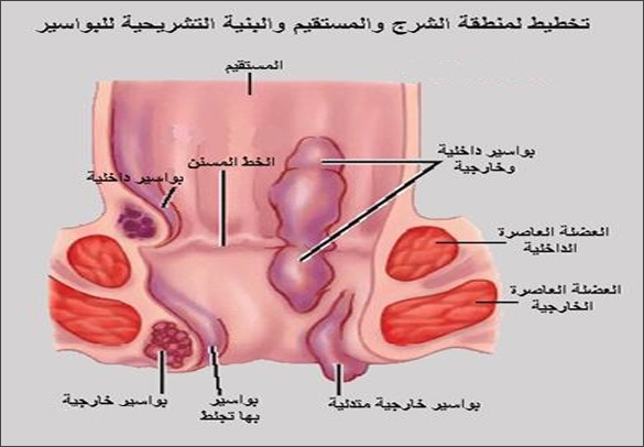 بالصور شكل البواسير , ماهو مرض البواسير