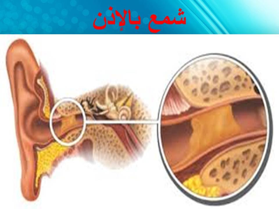 تنظيف الاذن بزيت الزيتون - طرق سحرية للتخلص من شحوم الاذن 1919