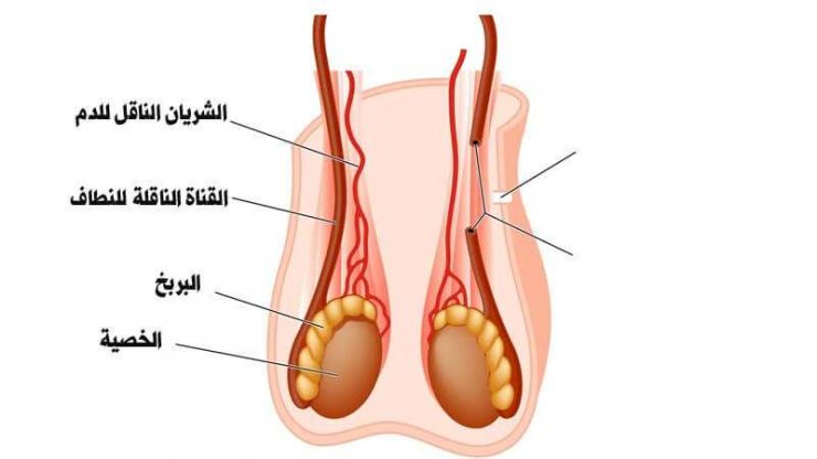 انتفاخ الخصية اليمنى بدون الم , اسباب انتفاخ الخصية دون الام