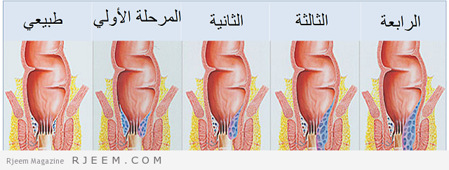 ما علاج البواسير - افضل علاج للبواسير 1442