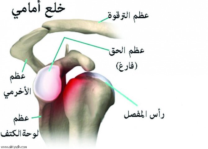 علاج خلع الكتف المتكرر بدون جراحة , اخطار خلع الكتف والاسعافات الاوليه لها