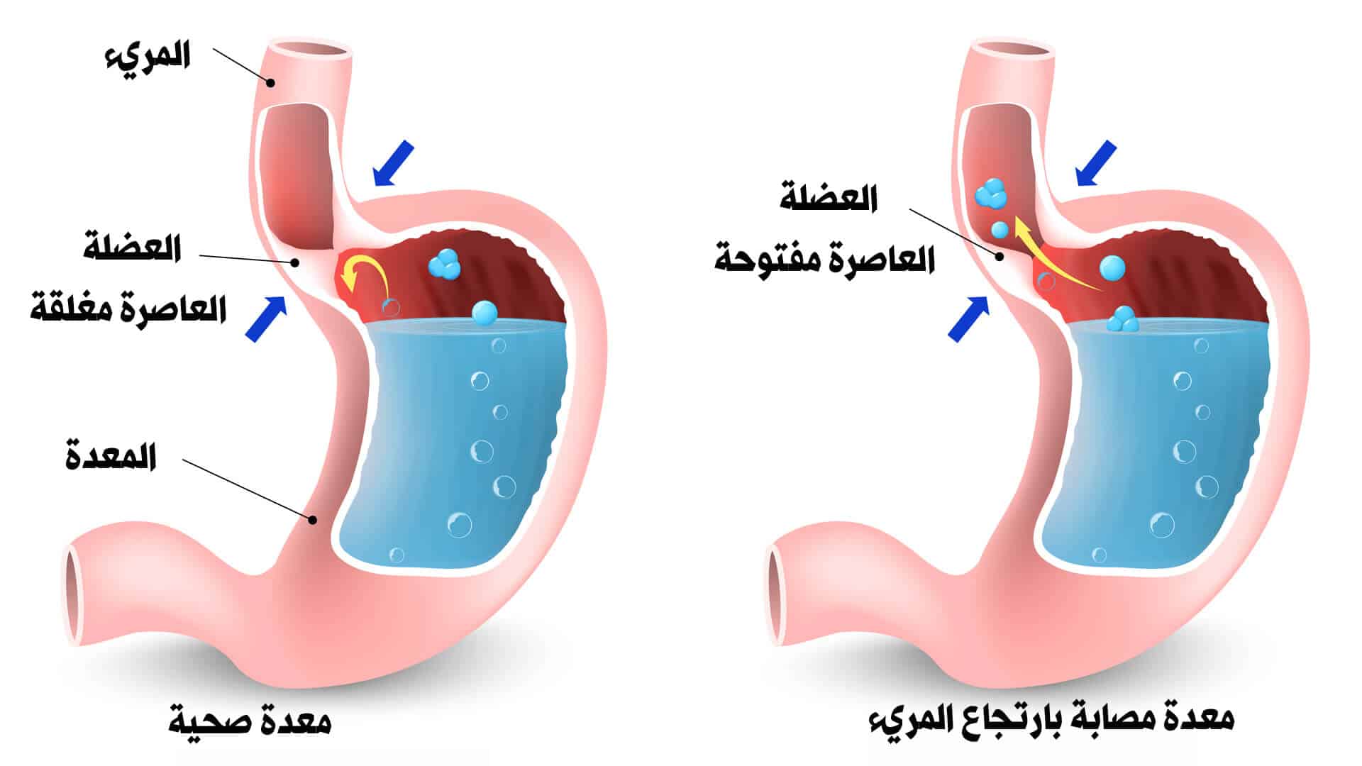 وصفات لعلاج مشكلة ارتجاع المريء ،علاج ارتجاع المرئ في الطب النبوي 5776 1