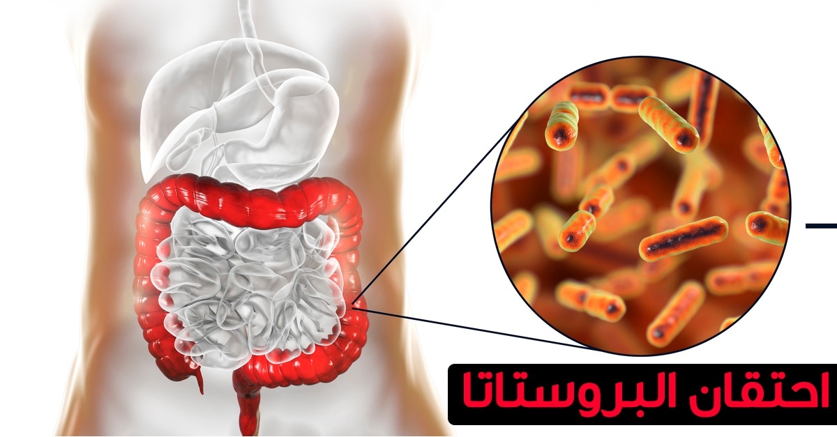 اعراض احتقان البروستاتا - لو شعرت بهذه الاشياء فالبروستاتا محتقنة فاحذر 266 2