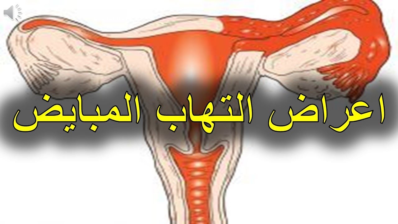 لماذا ينتج الم المبايض وما علاجه , سبب الم المبايض