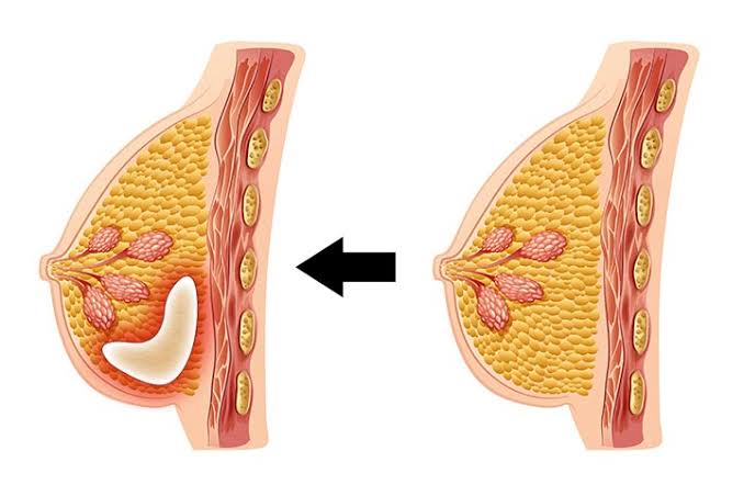 ماهي اسباب الام الثدي - حددى نوع ألمك تكتشفى طريقة علاجك 4928 1