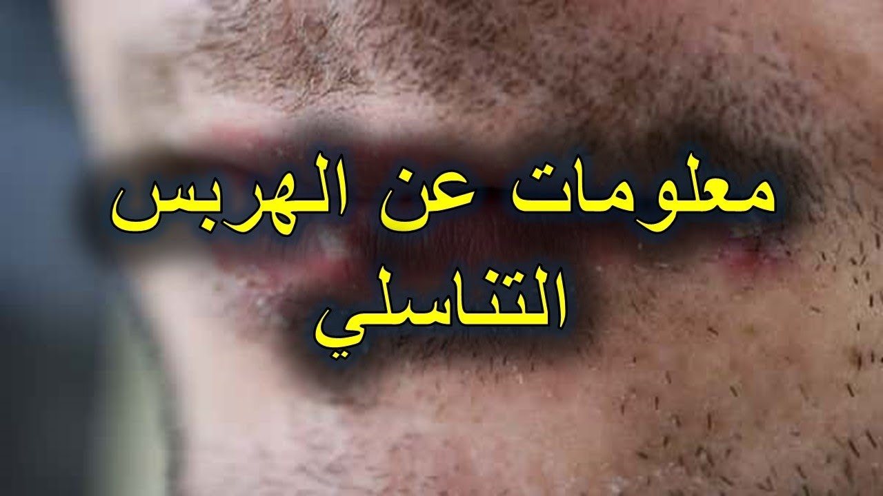 علاج الهربس التناسلي 5568