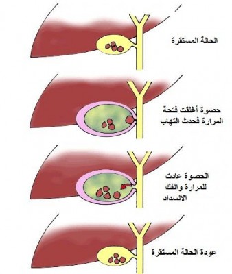 اسباب انتفاخ المرارة - ما لا تعرفه عن انتفاخ المرارة 3703 1