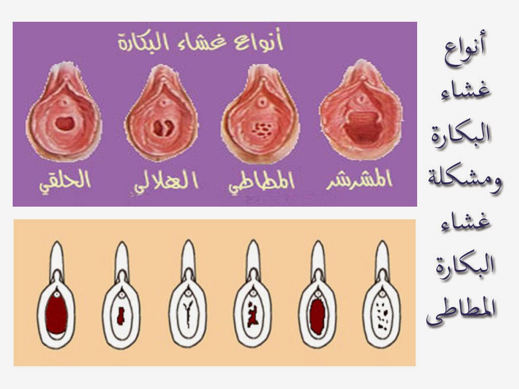 حجم فتحة المهبل عند العذراء - تعرفى عن نوع غشاء بكارتك - 4308 2