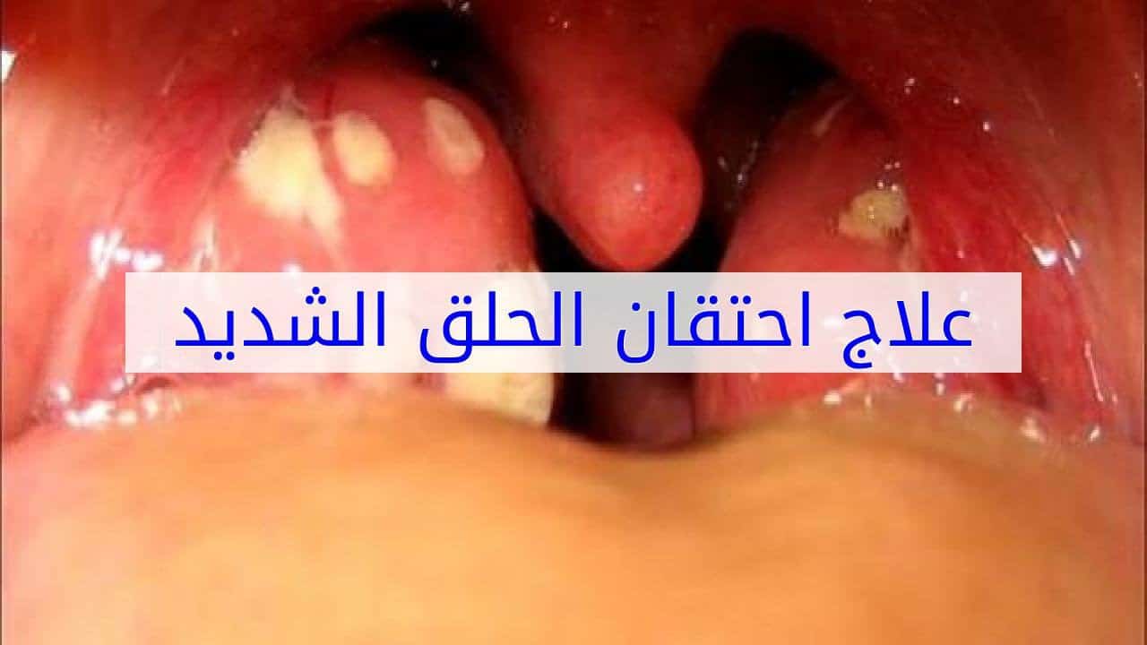 علاج الم الحلق , اسباب التهاب الحلق وطرق علاجه