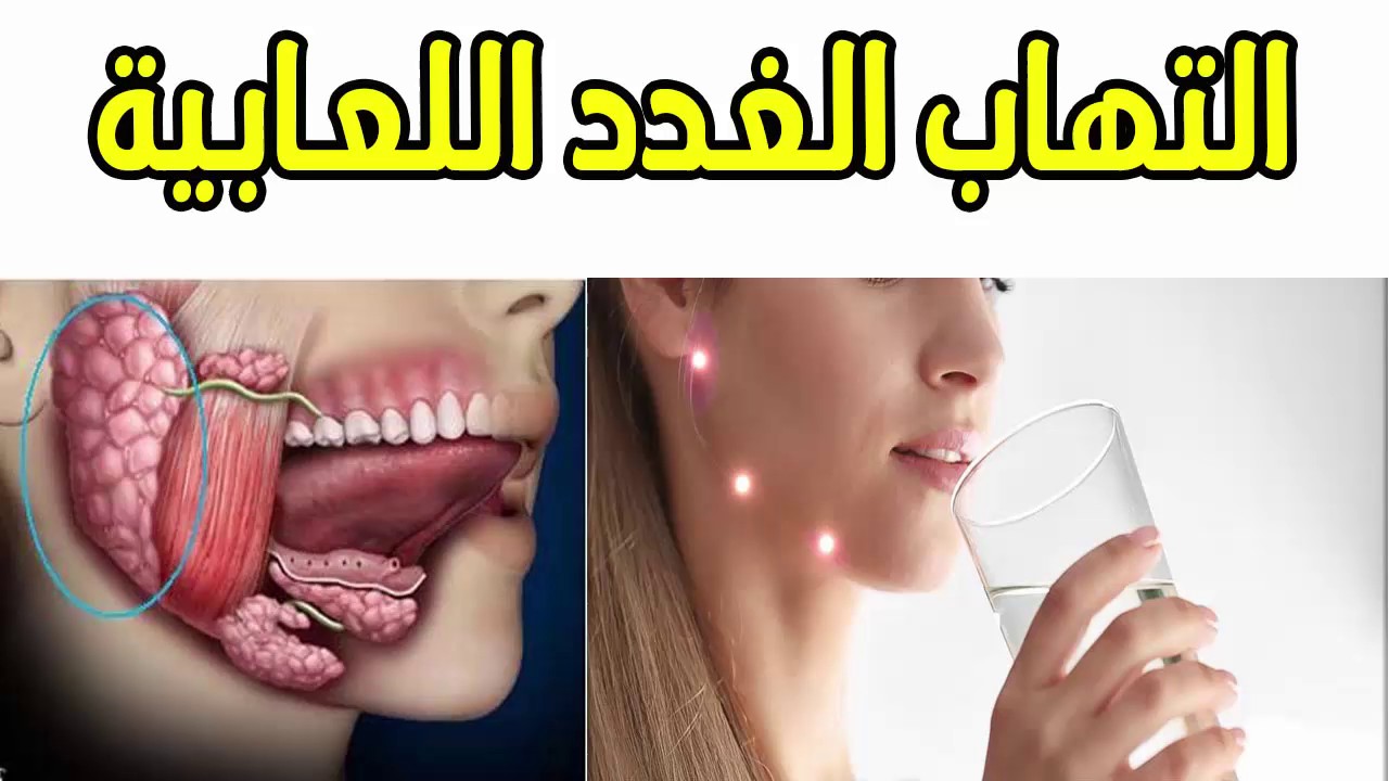 علاج الغدد اللعابية , التهاب الغدد اللعابية وعلاجها