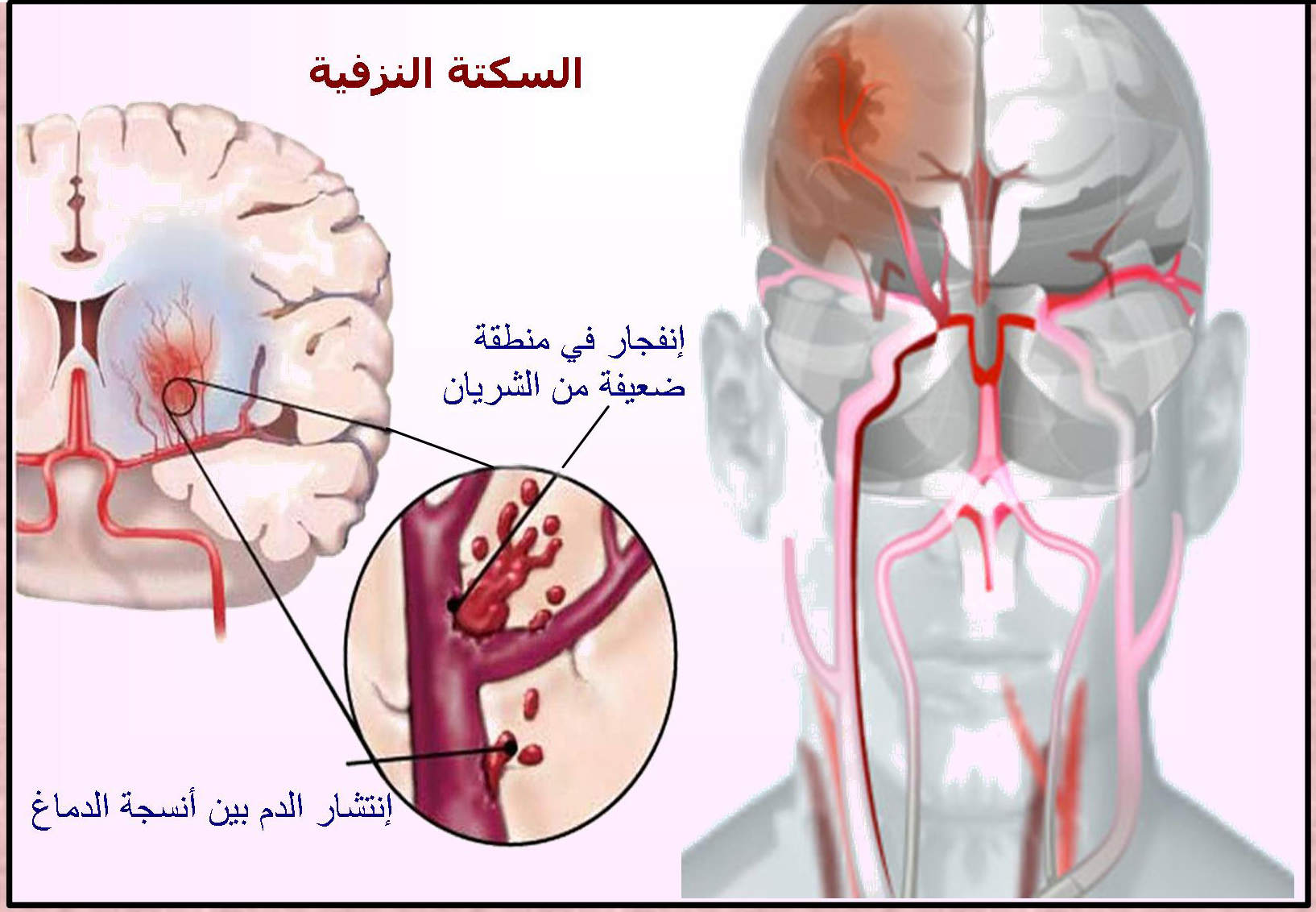 علاج تلف الدماغ بالقران - كيفية علاج ضمور الدماغ بالقران 2109