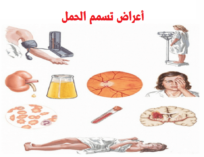 اسباب تسمم الحمل - اعرفى اعراض مهمة وعوامل خطيرة لتسمم الحمل 6011