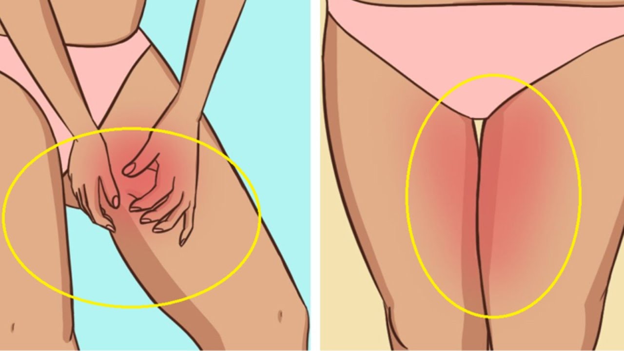 احمرار بين الفخذين - التهابات بين الفخذين 1077 2