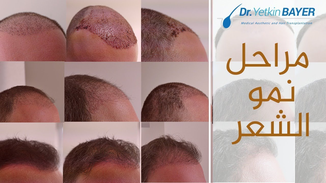 كيفية زراعة الشعر - مالا تعرفه عن زراعة الشعر 6755 2