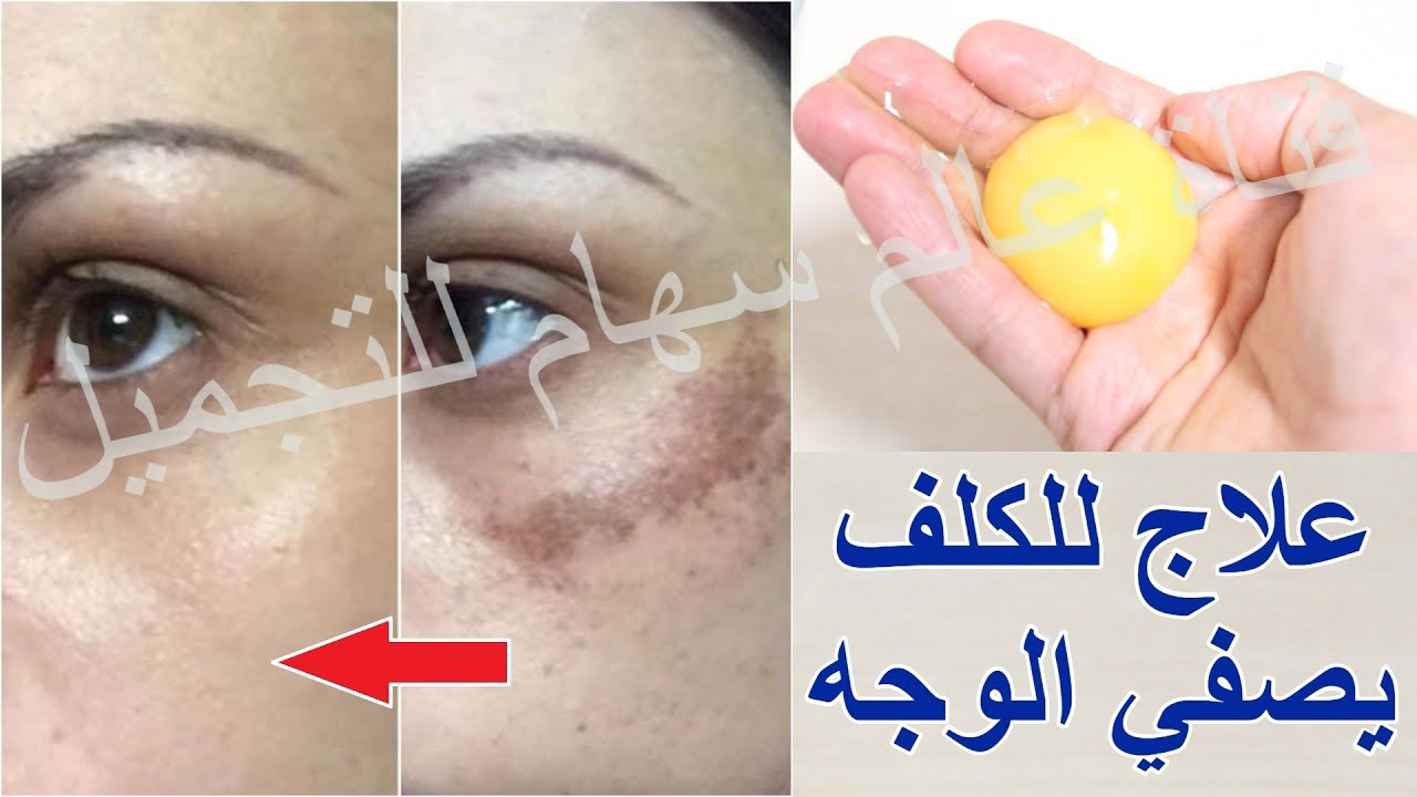 تخلصي من بقع الكلف في وجهك ،علاج الكلف في الوجه 5729 3