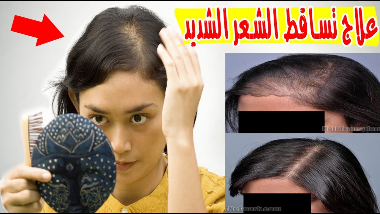 علاج تساقط الشعر الشديد 5414 1