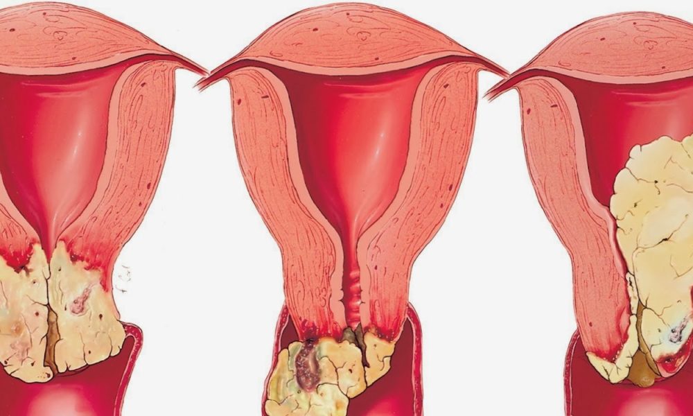 علاج فطريات المهبل , تخلصي من فطريات المهبل للابد بهذا المكون