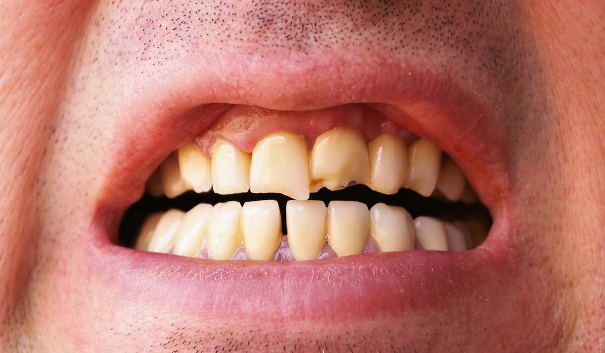 اسباب تكسر الاسنان اسباب تاكل الاسنان اغراء القلوب