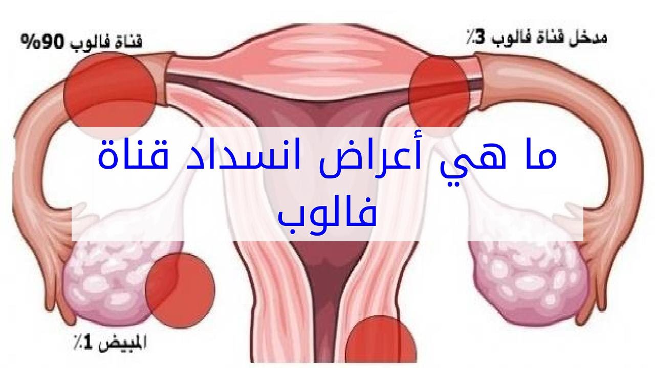 تاخر الحمل بسبب انسداد قناه فالوب , انسداد قناة فالوب